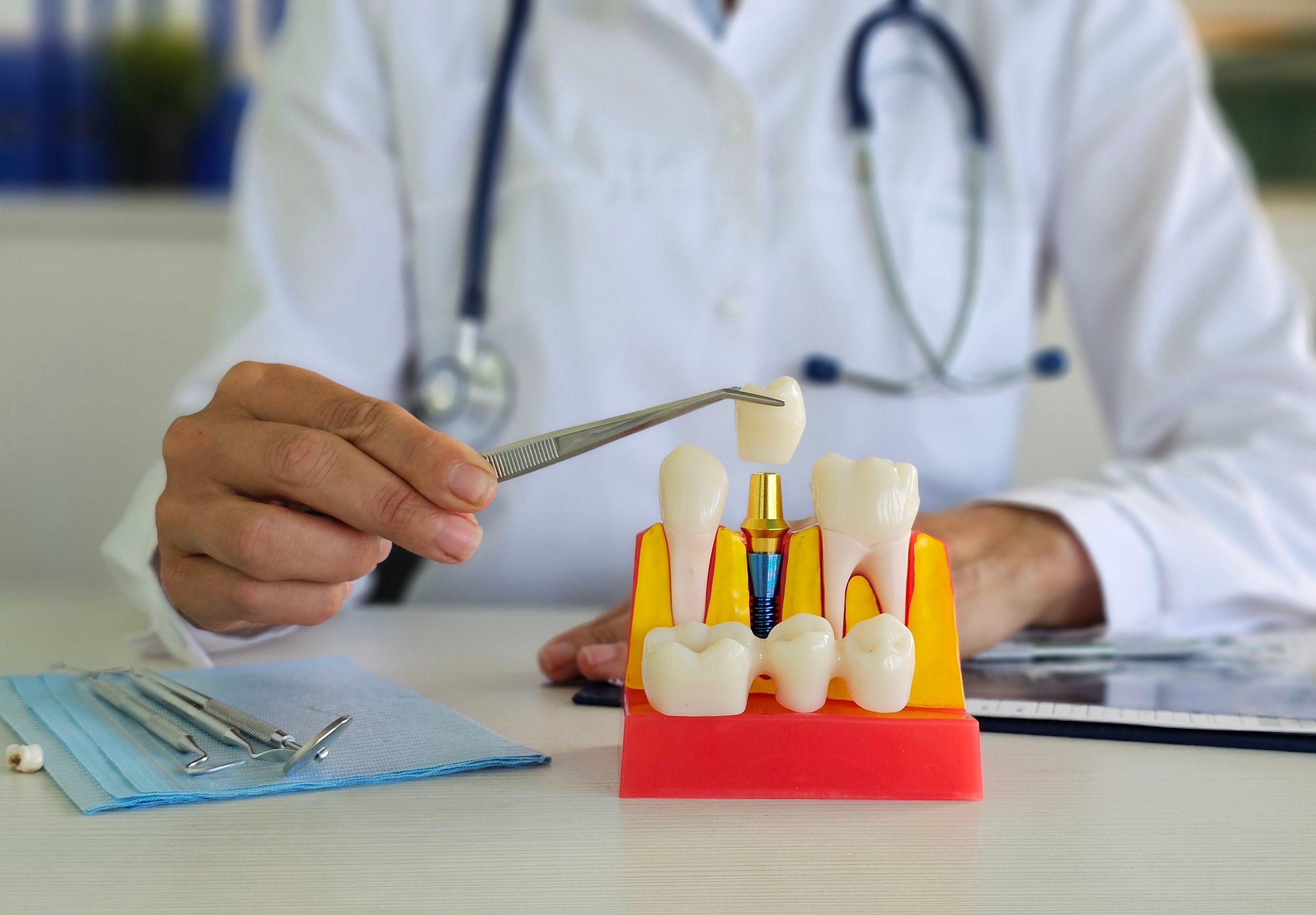 Dental Implants in Silver Spring