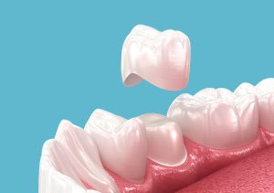 Silver Spring Dental Crowns
