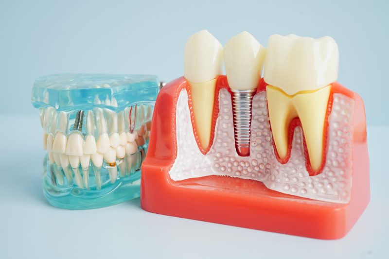 Dental Implants Silver Spring